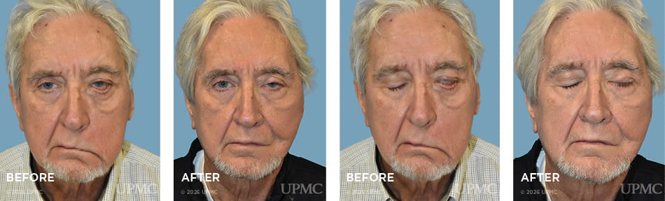 Fascia lata static suspension, lower lid tightening and placement of a platinum eyelid weight for flaccid facial paralysis following extirpation of a parotid tumor